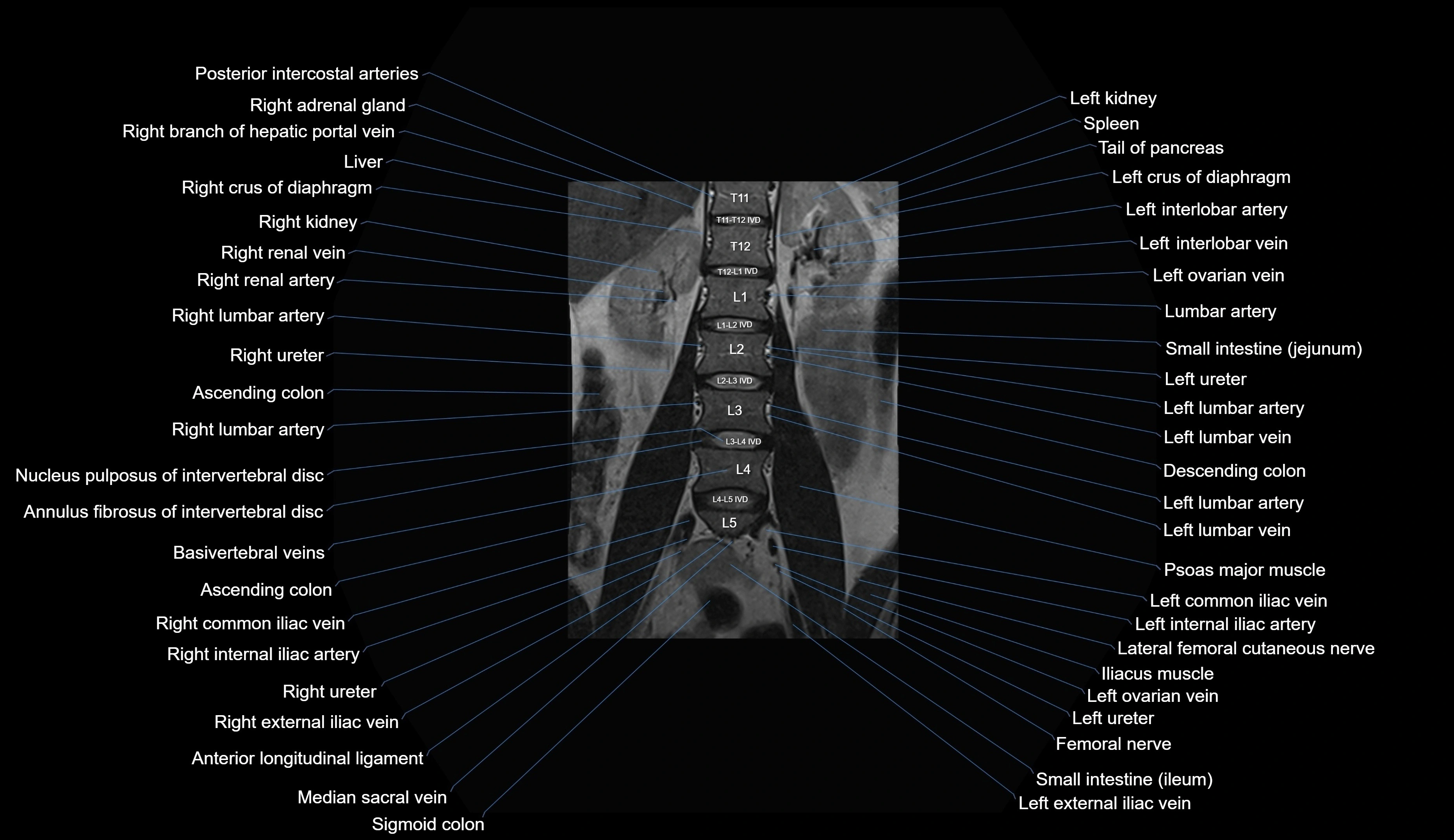 MRI lumbar spine coronal cross sectional anatomy 3T radiology  image-img-00001-00011.webp
